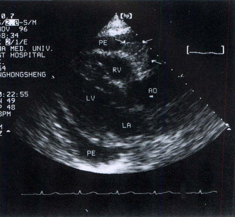 惡性腫瘤